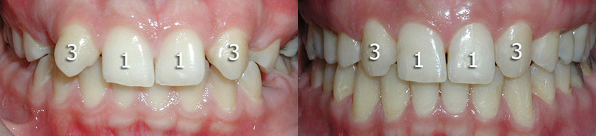 Missing Maxillary Lateral Incisors