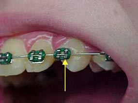 Broken Bracket (Separated From Tooth)