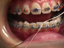 Start by flossing between the teeth until you hit the wire