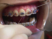 Floss around each tooth
